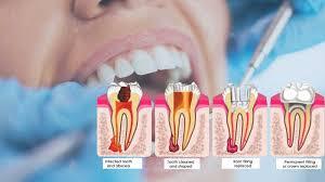 Root Canal Therapy Navi Mumbai